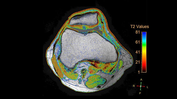 cartilage assessment thumbnail