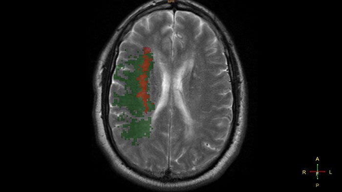 magnetic resonance t2 neuro