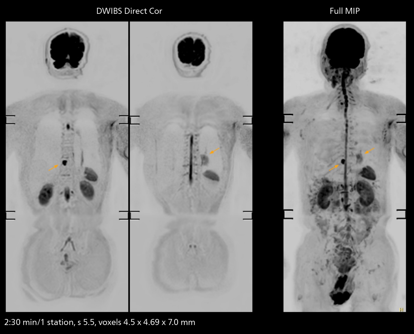 Whole body mri two