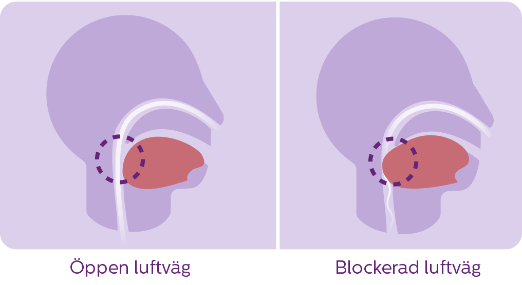 sömnapnédiagram