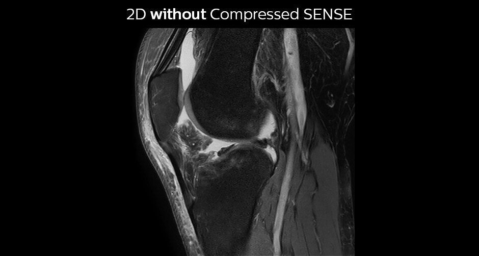 PD FS SPIR knee WITHOUT Compressed SENSE sag
