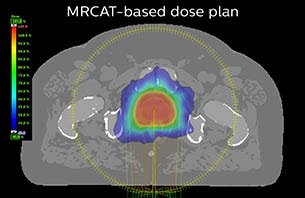Turku MRCAT based dose plan case 7