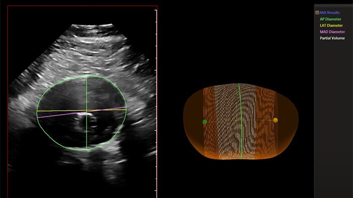 Abdominal aortic thumbnail