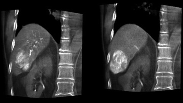 Optimal artery and tumor visualization with CBCT Dual