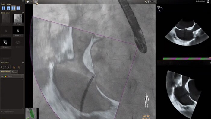 EchoNav models aorta mitral