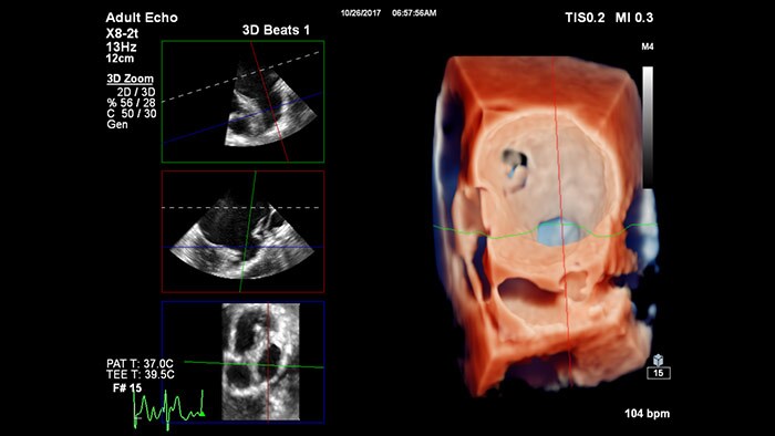 TrueVue of 3D Zoom rendering for LAA with MultiVue visualization