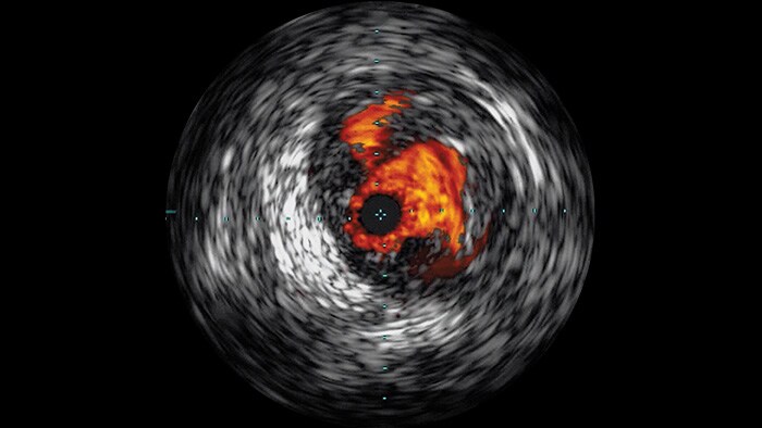 Intravasular Ultrasound (IVUS)