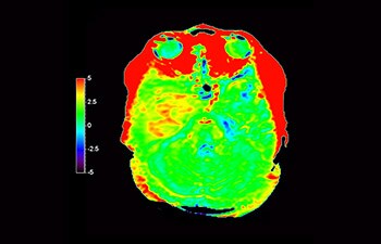 Astrocytoma 3d apt