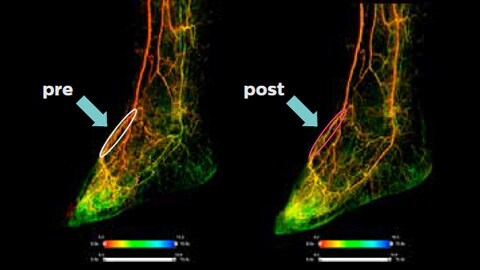 Dorsalis Pedis Artery (DPA)