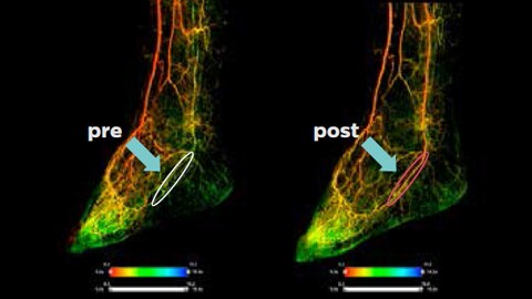 Posterior Tibial Artery (PTA)