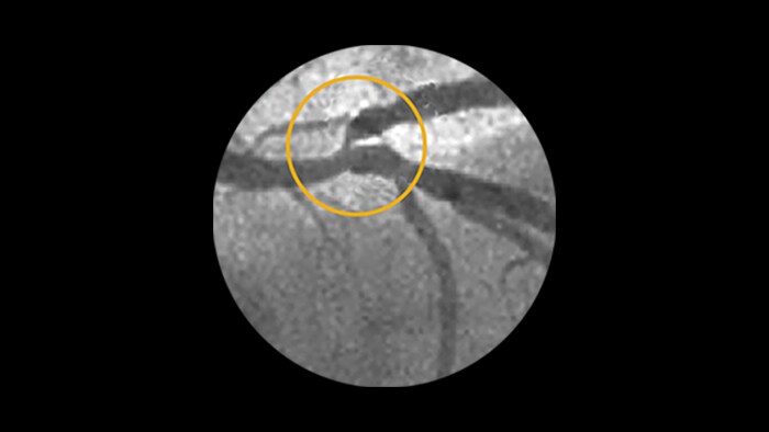 Ostial and bifurcation lesions