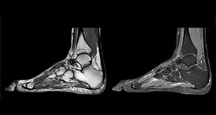 Lefebvre Case1 Ankle thmb
