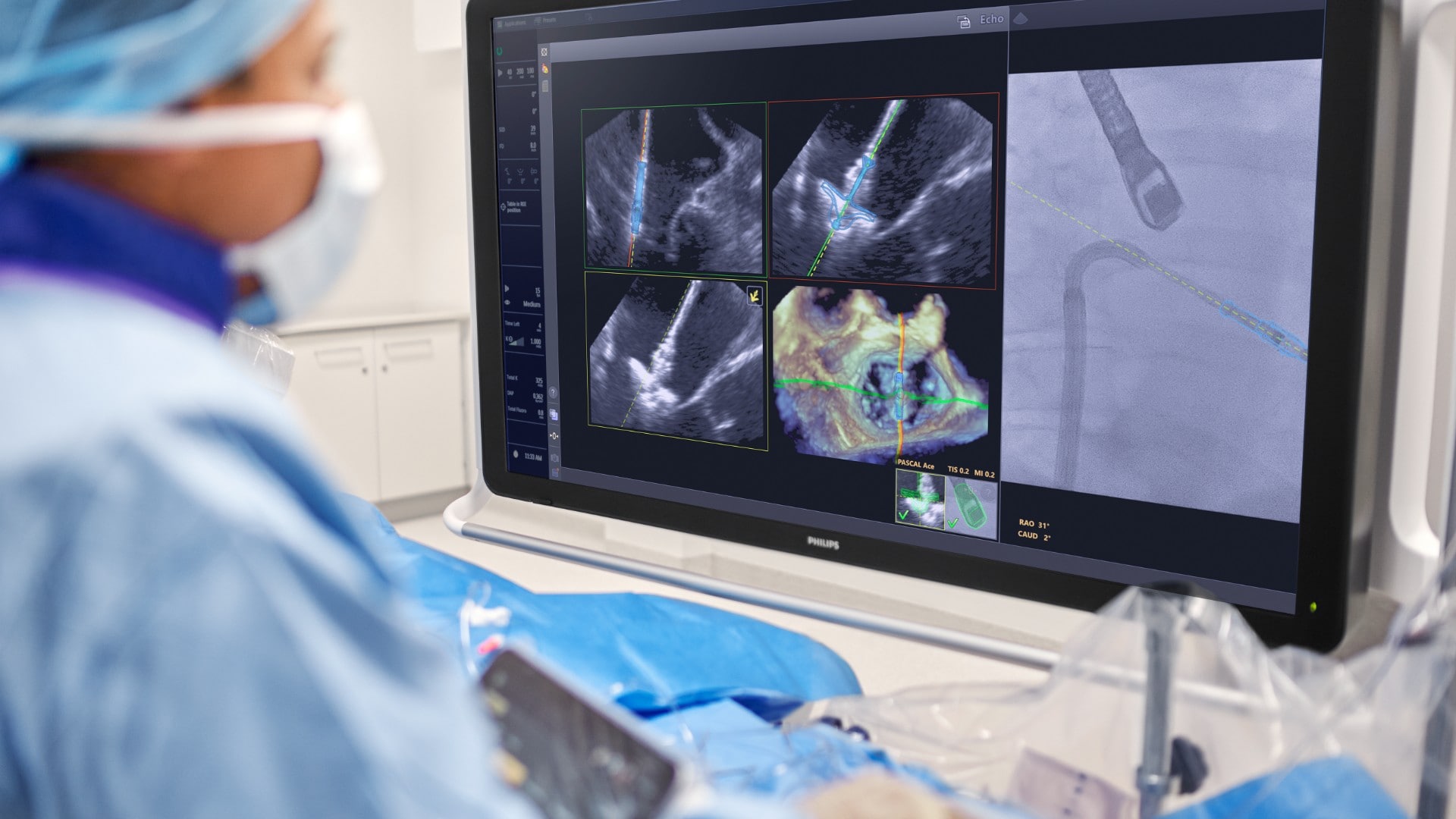 Philips för in AI i hjärtat av operationssalen – stöttar läkare i realtid under hjärtklaffsreparation